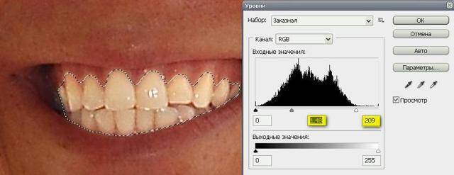Как проводится отбеливание зубов в стоматологии? – стоматология президент