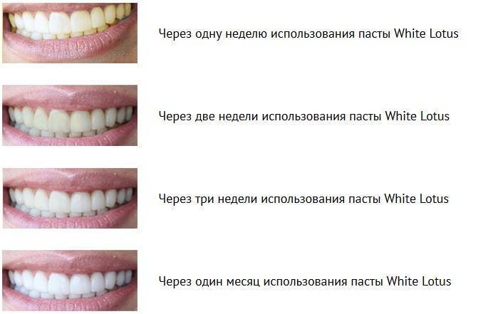 Какое отбеливание зубов самое эффективное и безопасное: виды и способы в стоматологии