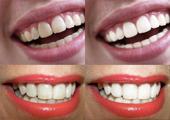 Как отбелить зубы дома без вреда для эмали? | дентарт