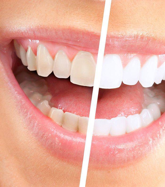 На сколько тонов можно отбелить зубы
