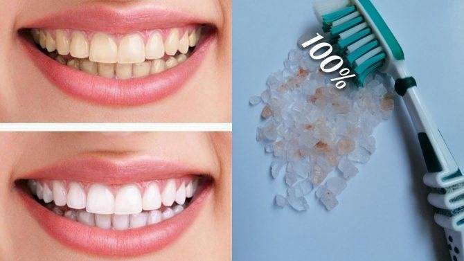 Способы отбеливания зубов: обзор лучших методов