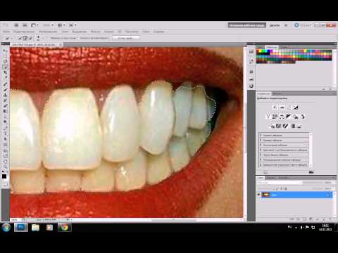 Виды отбеливания зубов – плюсы и минусы